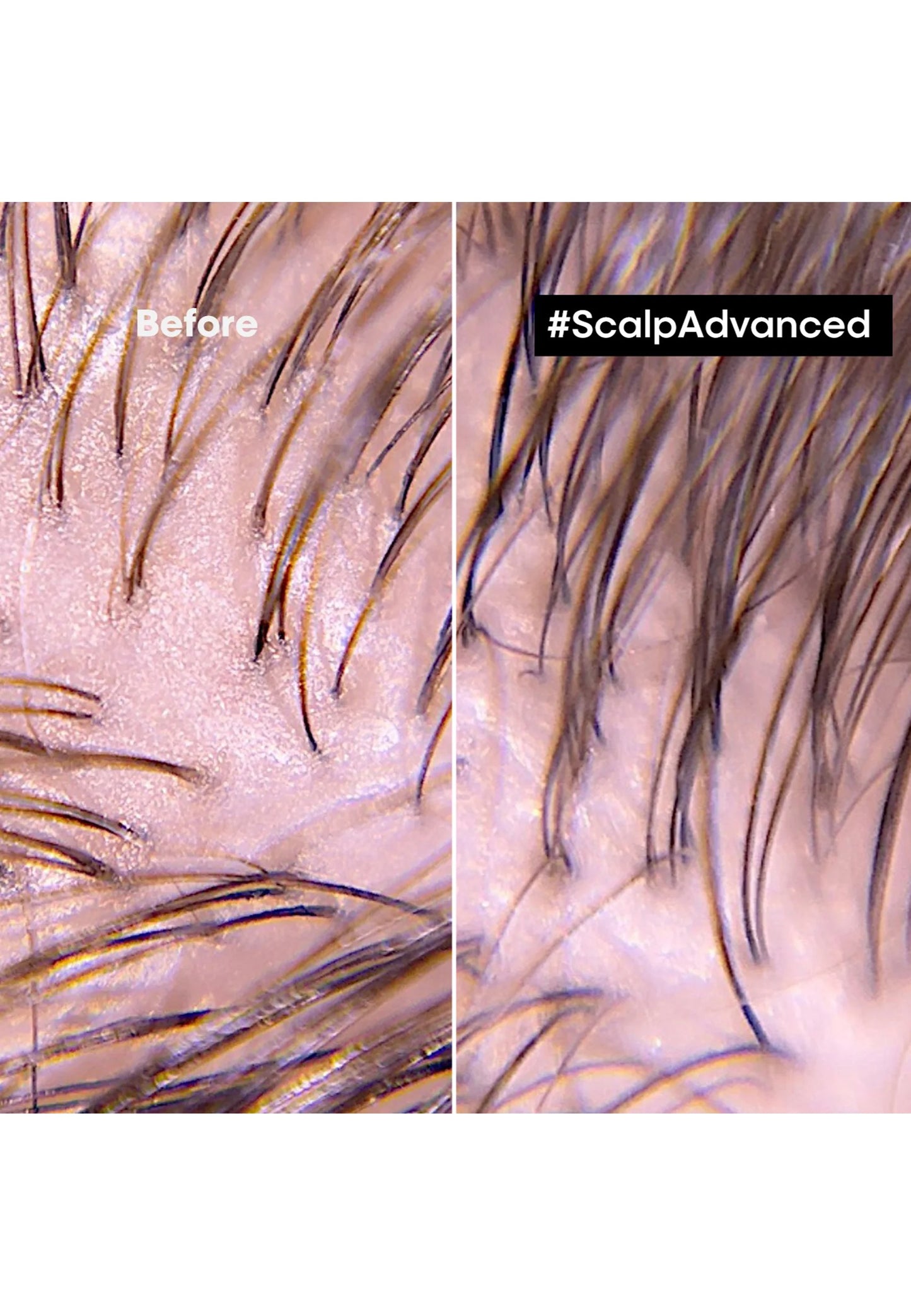 L'Oreal Professionnel- Scalp Advance Trattamento professionale